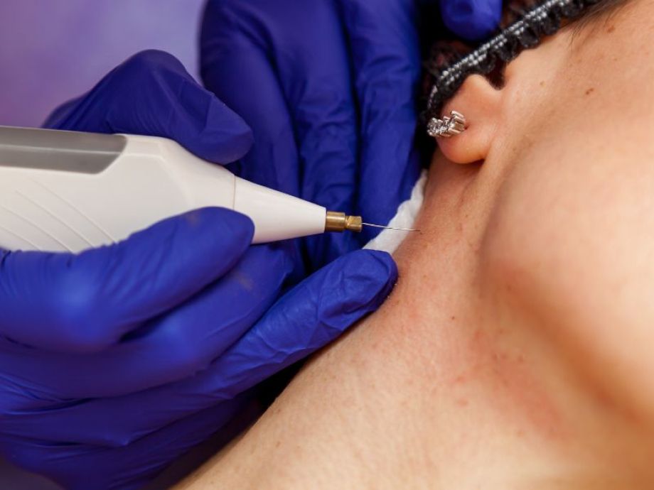 Electrocoagulações e Curetagens - Drª. Bárbara Pereira Dermatologista - Drª. Bárbara Pereira Dermatologista