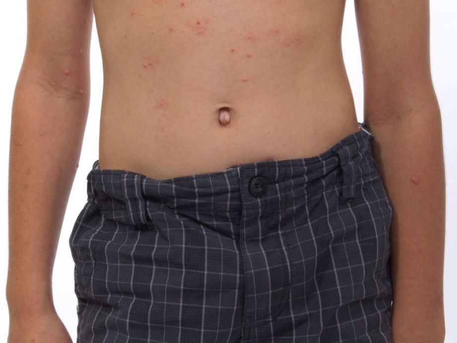 Moluscos - Drª. Bárbara Pereira Dermatologista