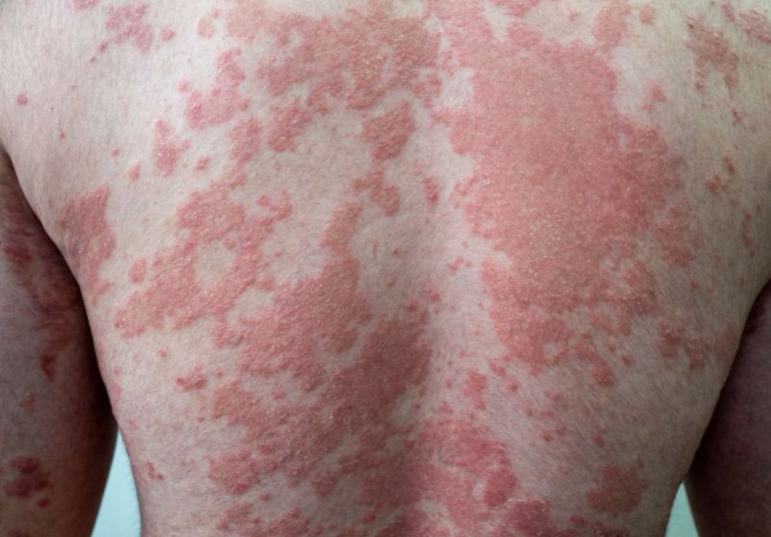 Psoríase Dermatologia - Dra Bárbara Pereira