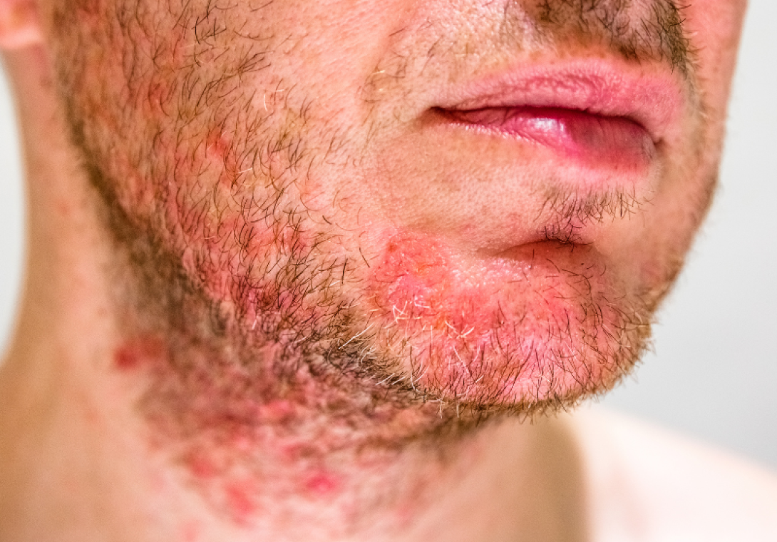 Dermatite Dermatologia - Dra Bárbara Pereira