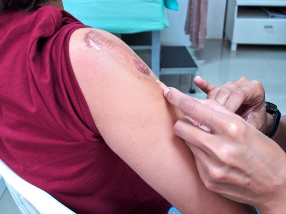  Corticoterapia Intralesional -  Drª. Bárbara Pereira Dermatologista