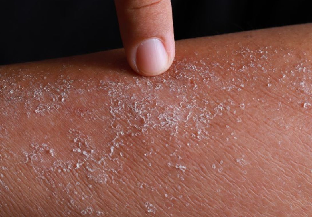 Eczema Dermatologia - Dra Bárbara Pereira