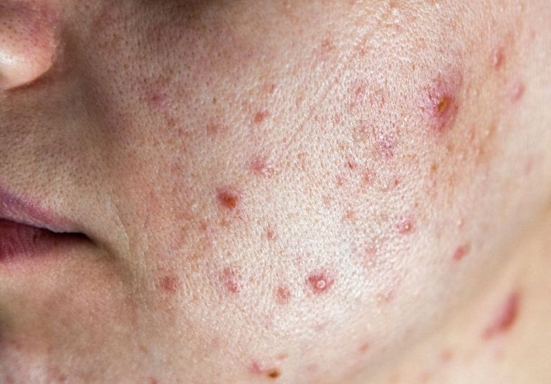 Acne Dermatologia - Dra Bárbara Pereira