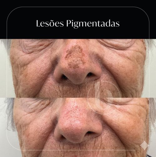 Lesões Pigmentadas benignas