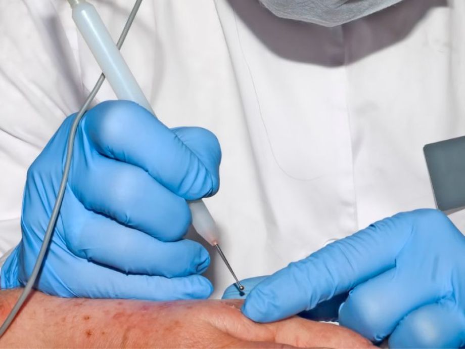 Electrocoagulações e Curetagens - Drª. Bárbara Pereira Dermatologista