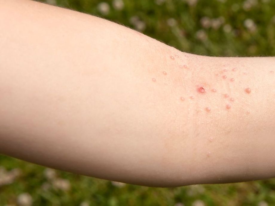 Moluscos - Drª. Bárbara Pereira Dermatologista