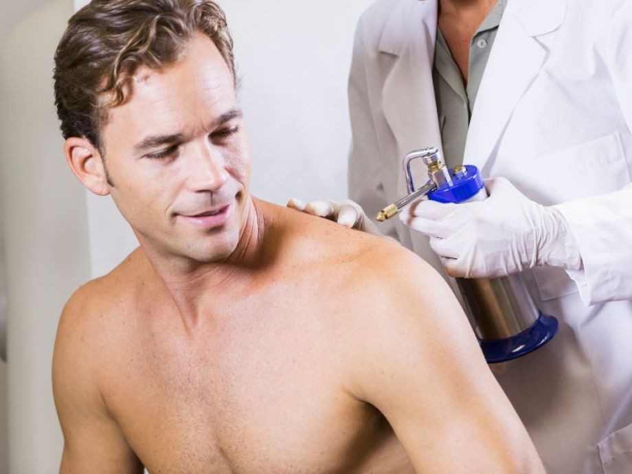 Crioterapia com Azoto líquido -  Drª. Bárbara Pereira Dermatologista