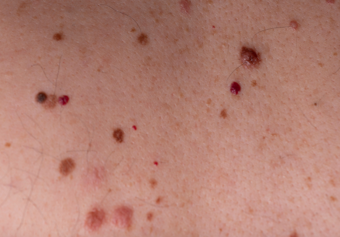 Nevo Dermatologia - Dra Bárbara Pereira