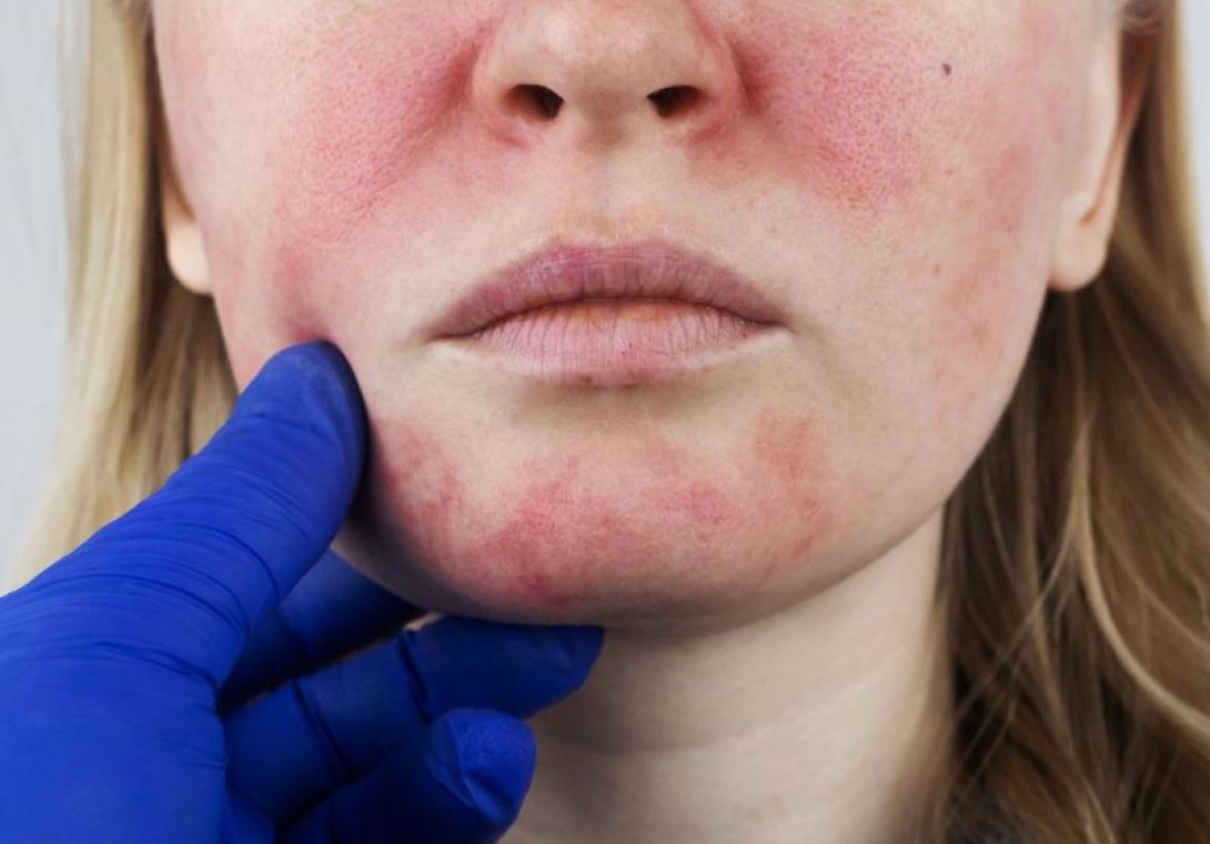 Rosácea Dermatologia - Dra Bárbara Pereira