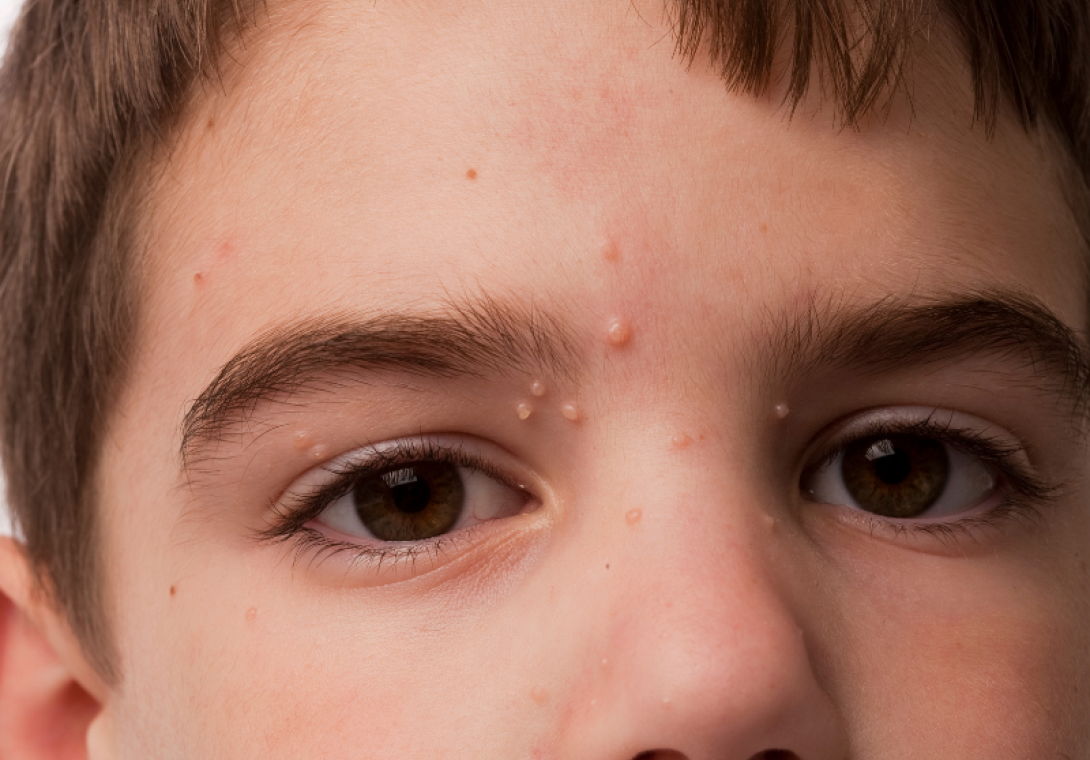 Moluscos Dermatologia - Dra Bárbara Pereira