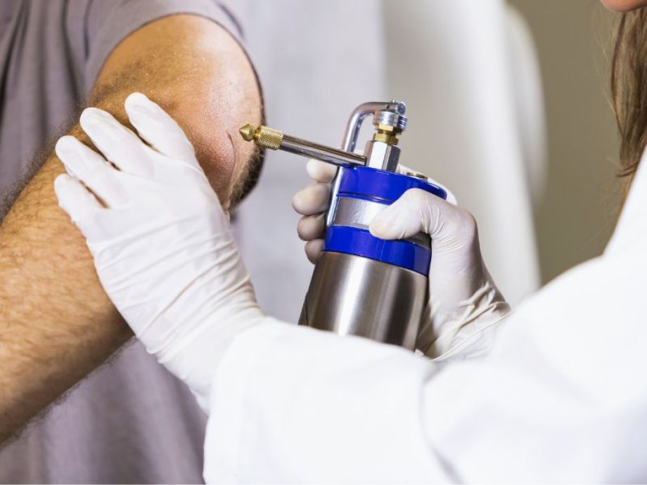 Crioterapia com Azoto líquido -  Drª. Bárbara Pereira Dermatologista