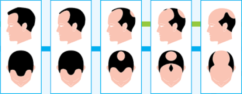 Alopécia Androgenética